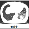 隨州市中心醫(yī)院：【特色技術(shù)】微創(chuàng)技術(shù)新突破，冷凍消融治療精準(zhǔn)“凍殺”癌細(xì)胞