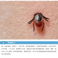 隨州市中心醫(yī)院提醒：小小蜱蟲需警惕！——發(fā)熱伴血小板減少綜合征科普知識(shí)