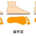 【義診預(yù)告】千里之行，始于“足”下，扁平足免費篩查來了