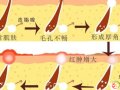 隨州市中心醫(yī)院：關(guān)于“雞皮膚”的那些事兒