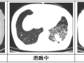 隨州市中心醫(yī)院：【特色技術(shù)】微創(chuàng)技術(shù)新突破，冷凍消融治療精準(zhǔn)“凍殺”癌細(xì)胞